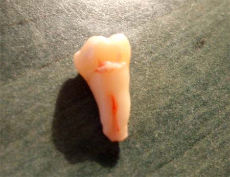 der letzte weisheitszahn