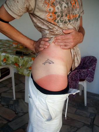 leichter sonnenbrand bei springhuhn..