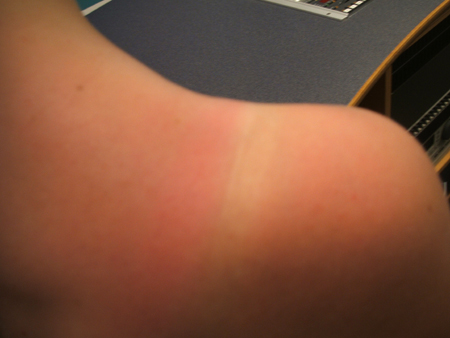 die sonne hinterl��t ihre spuren..