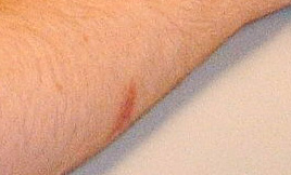 wie wird sich die armwunde entwickeln?