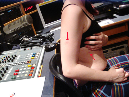 nur heute: chrissy zeigt ihre m�ckenstiche!