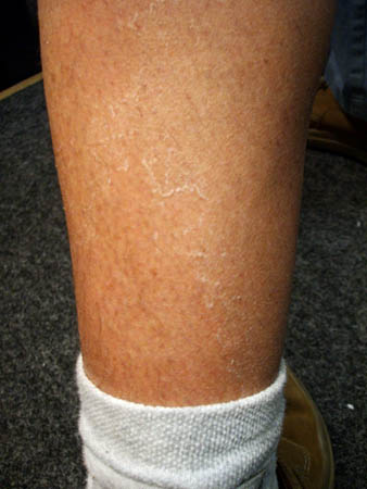 springhuhns abbl�tternde haut..